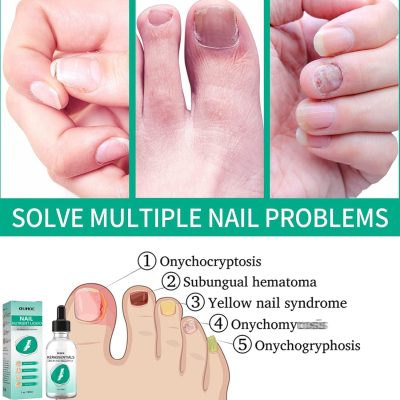 kerassentials for toenail fungus kerassentials for toenail fungus